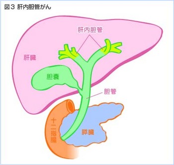 肝内胆管がん.jpg